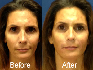 juvederm3