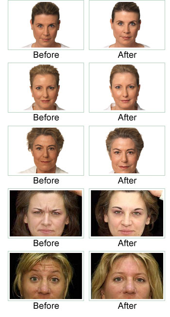 Some Of Botox Injections Beverly Hills & Los Angeles thumbnail