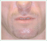 Sculptra in Los Angeles