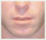 Sculptra Aesthetic in Los Angeles