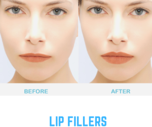 Facial Fillers in Los Angeles